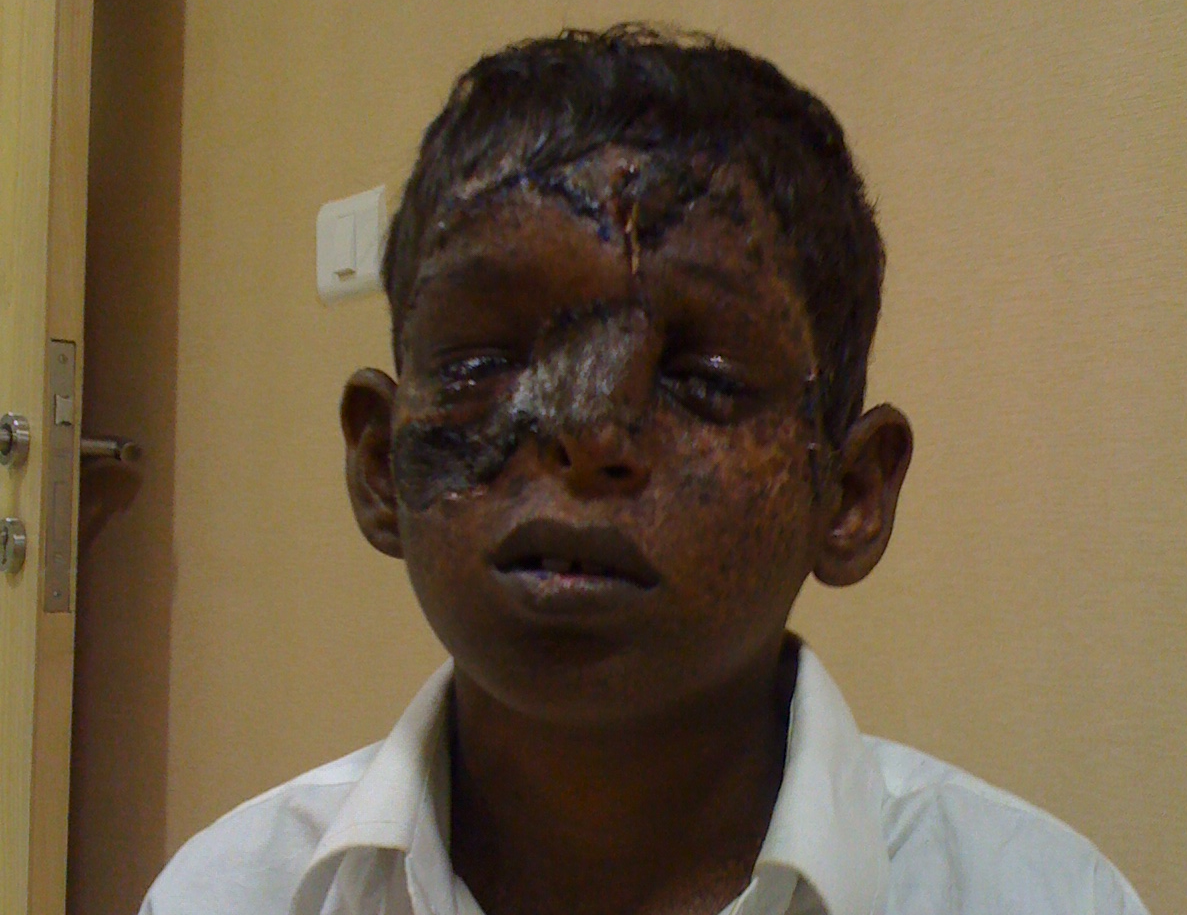 Bhargav After Operation 2