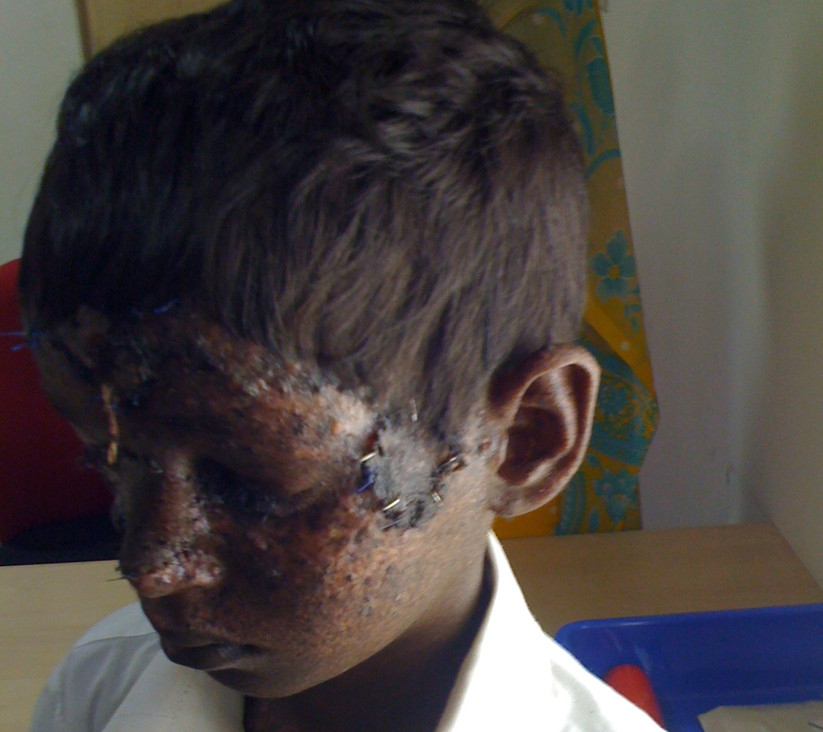 Bhargav After Operation 4